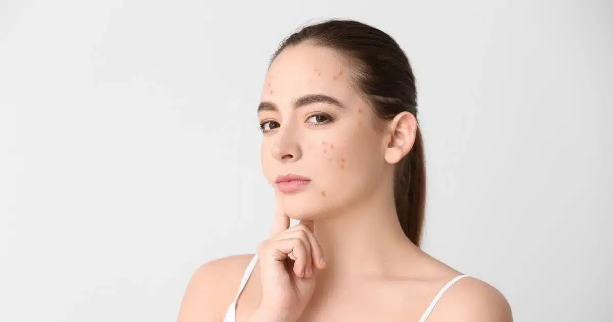 Close-up of woman's face with acne.