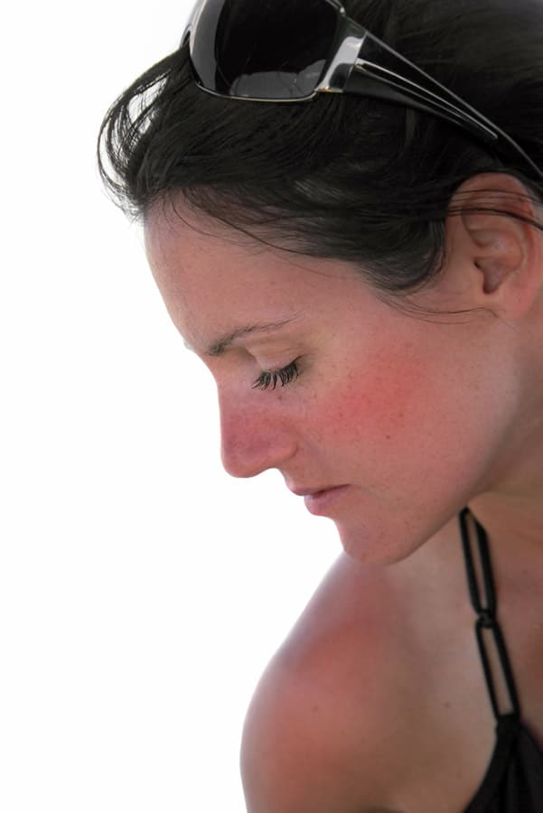 Woman with sunburn which can exacerbate large pores