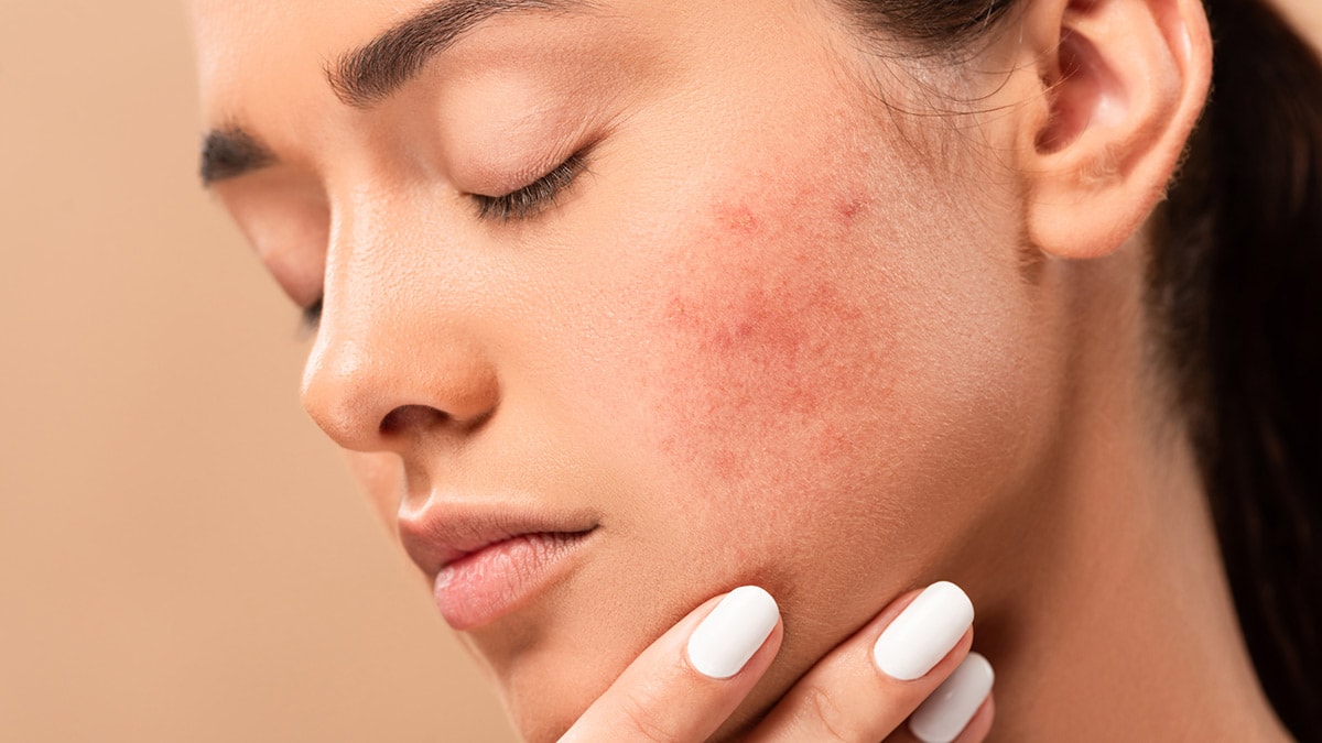 close up of woman with acne scars