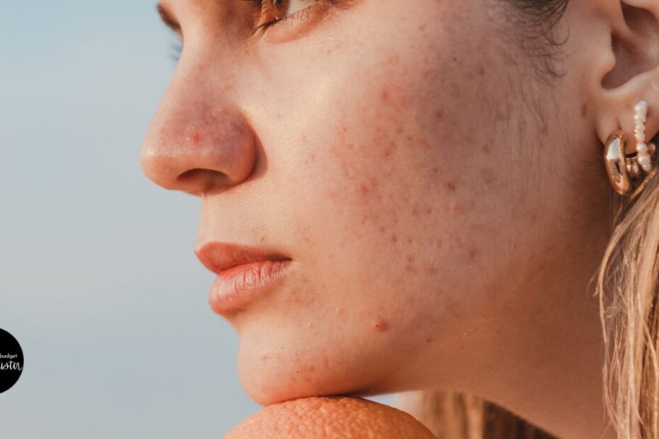 Close up of woman with acne blemishes